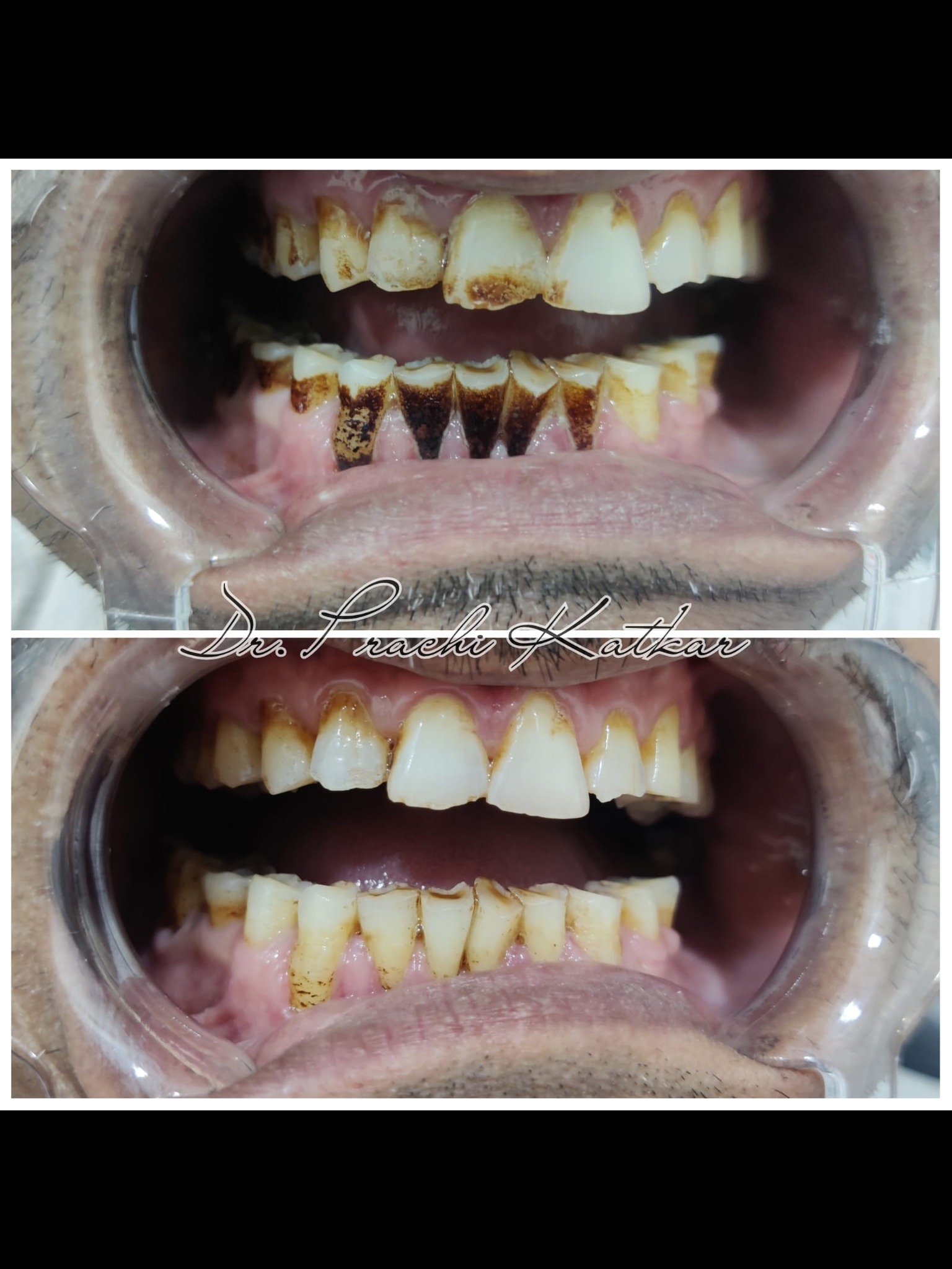 Cavity cleaning