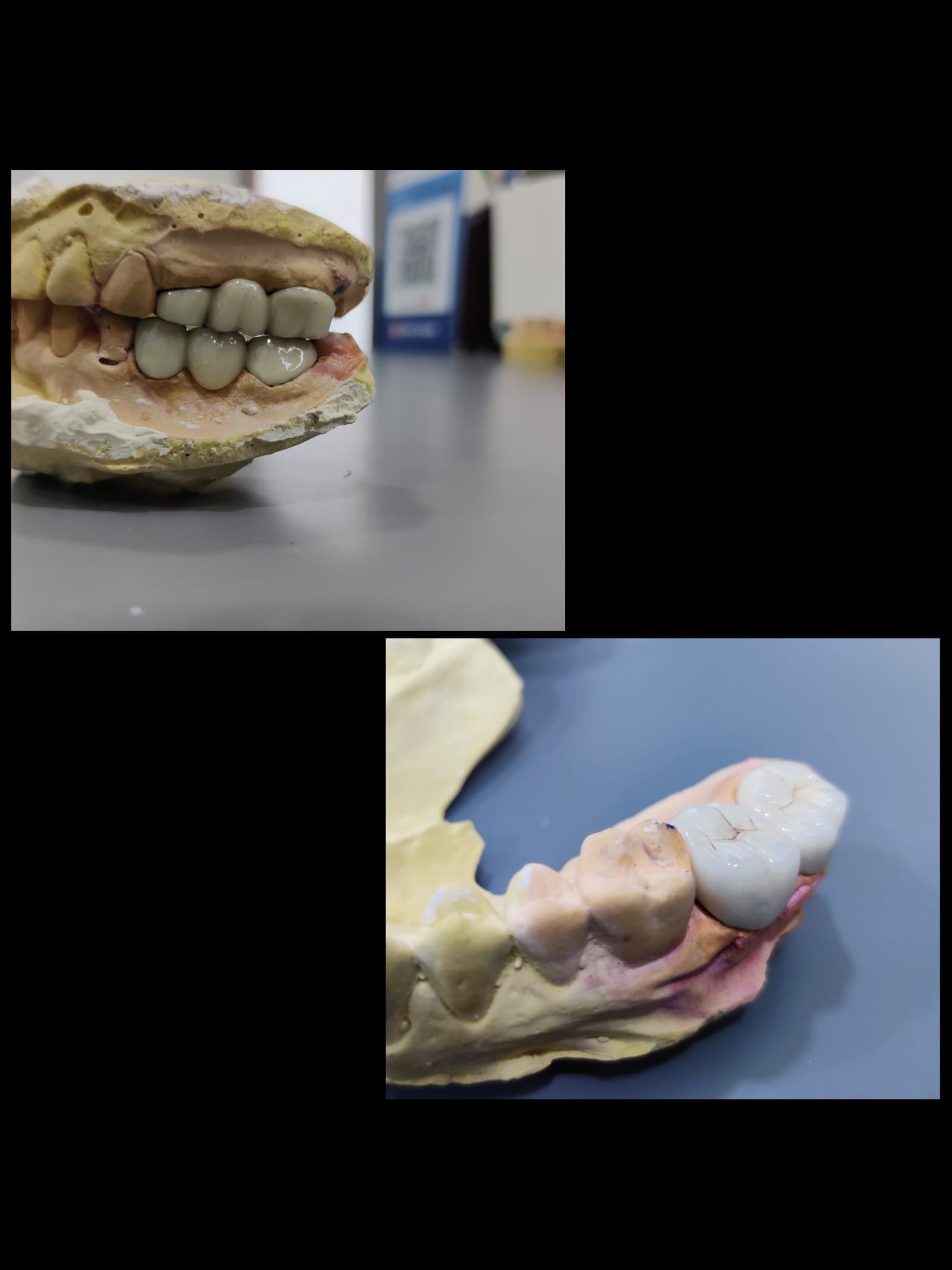 Implants