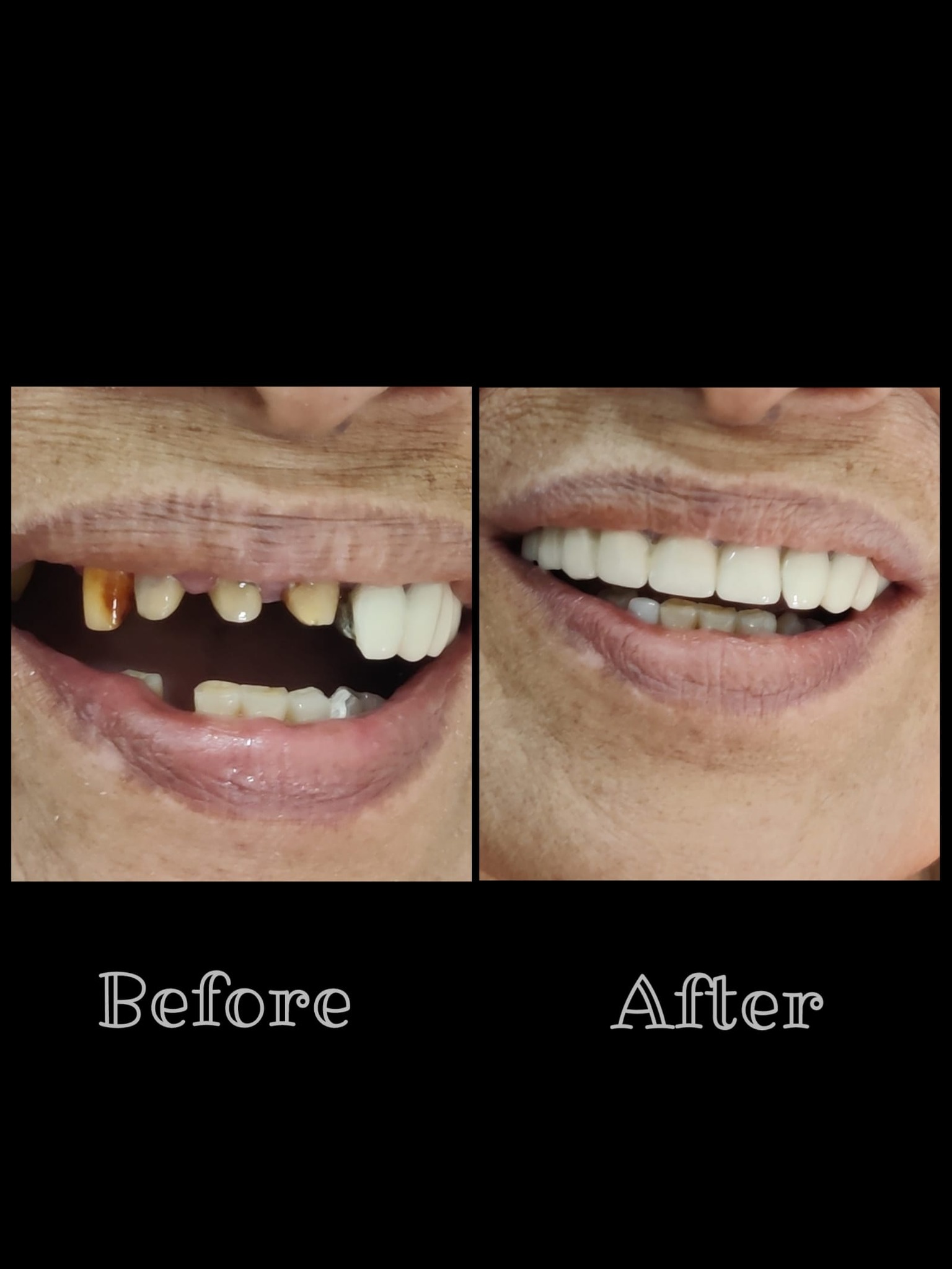 Teeth whitening before and after